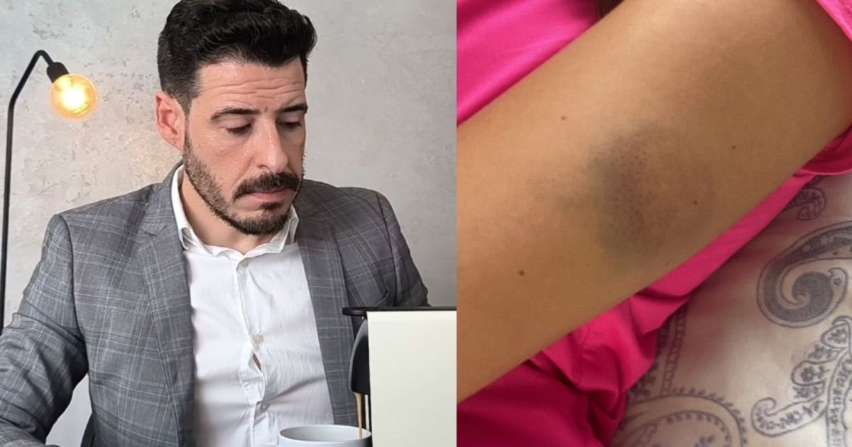 Thiago Schutz, à esquerda; foto da agressão no corpo da vítima, à direita  • Reprodução
